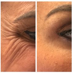 Tratamiento antiarrugas