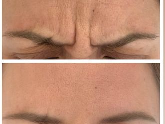 Eliminación arrugas antes y después - 877915
