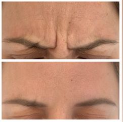 Tratamiento antiarrugas