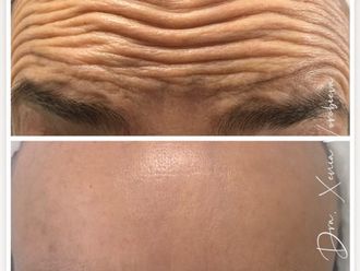 Eliminación arrugas antes y después - 877916