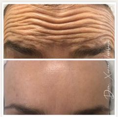 Tratamiento antiarrugas