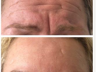 Eliminación arrugas antes y después - 877917