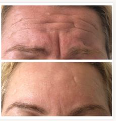 Tratamiento antiarrugas