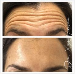 Tratamiento antiarrugas