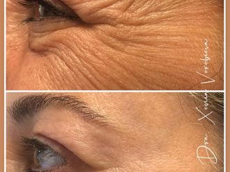 Eliminación arrugas antes y después - 877955