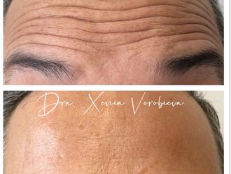 Eliminación arrugas antes y después - 877956