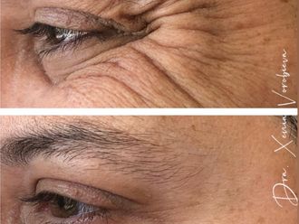 Eliminación arrugas antes y después - 877957