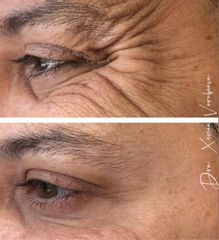 Tratamiento antiarrugas hombre