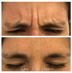 Tratamiento antiarrugas