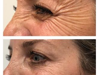 Eliminación arrugas antes y después - 877959