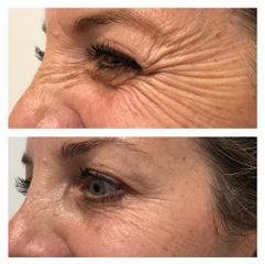 Tratamiento antiarrugas