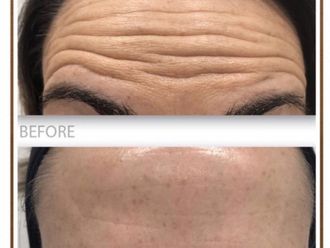 Eliminación arrugas antes y después - 877960