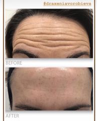 Tratamiento antiarrugas