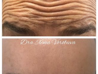 Eliminación arrugas antes y después - 877961