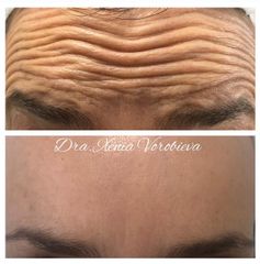 Tratamiento antiarrugas