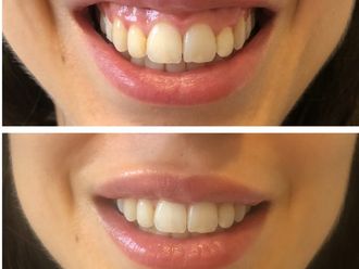 Ácido hialurónico antes y después - 877962