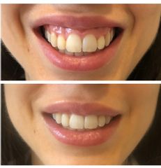 Tratamiento de la sonrisa gingival