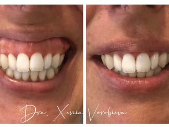 Ácido hialurónico antes y después - 877963