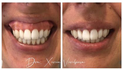 Tratamiento de la sonrisa gingival