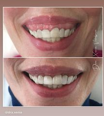 Tratamiento de la sonrisa gingival
