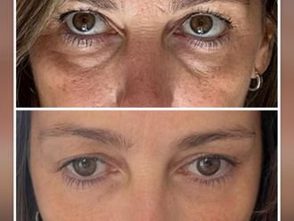 Eliminación ojeras antes y después - 877965