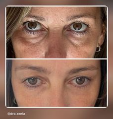 Tratamiento de las ojeras