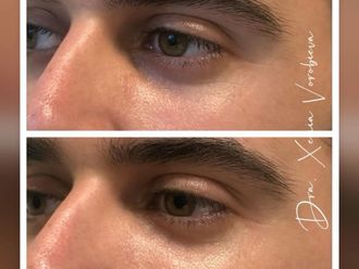 Eliminación ojeras antes y después - 877966