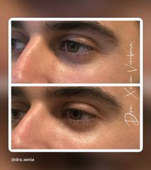 Tratamiento de las ojeras