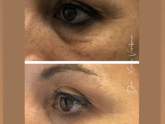 Eliminación ojeras antes y después - 877967