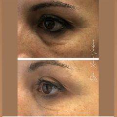 Tratamiento de las ojeras