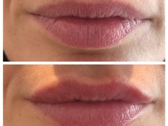 Ácido hialurónico antes y después - 877968