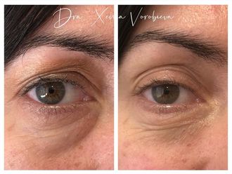 Eliminación ojeras antes y después - 877970