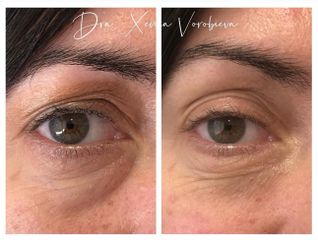 Tratamiento de las ojeras