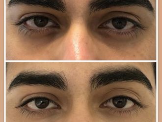 Ácido hialurónico antes y después - 878804