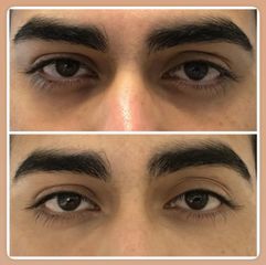 Tratamiento de las ojeras