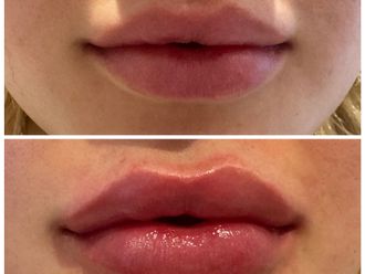 Ácido hialurónico antes y después - 878805