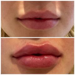 Tratamiento labios