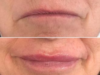 Aumento labios antes y después - 879572
