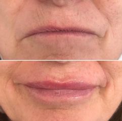 XV Clinic - Aumento de Labios