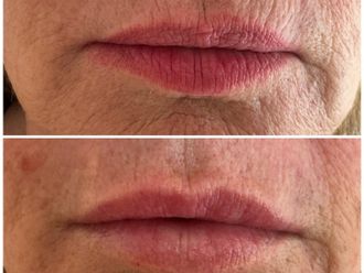 Aumento labios antes y después - 879573
