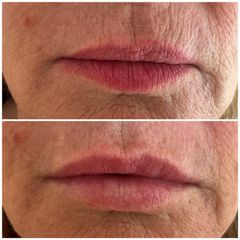 XV Clinic - Aumento de Labios