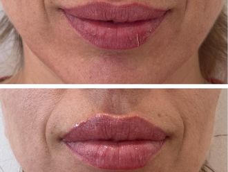 Aumento labios antes y después - 879574