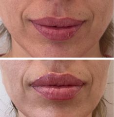 XV Clinic - Aumento de Labios