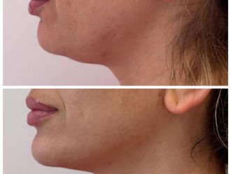 Radiofrecuencia facial antes y después - 879577