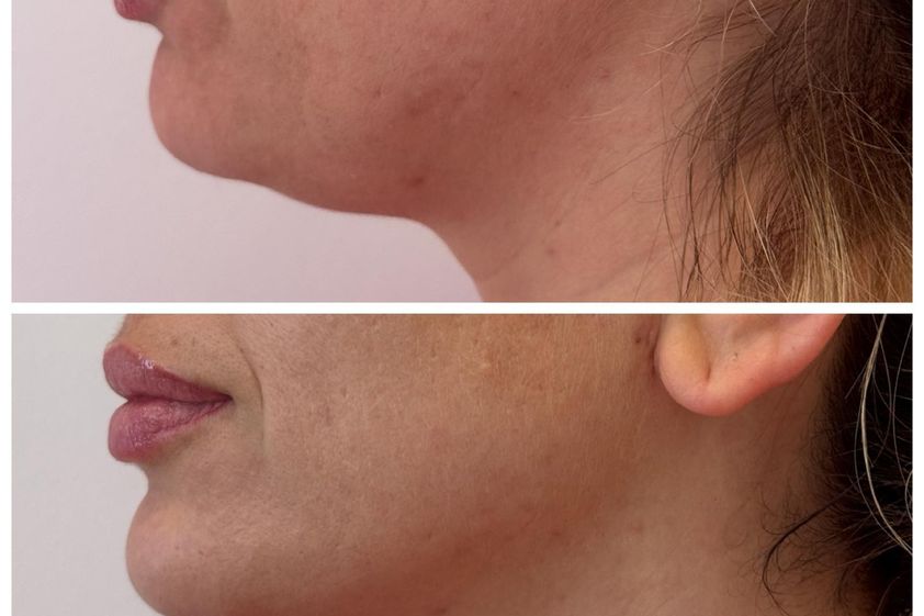 Radiofrecuencia facial antes y después - 879577