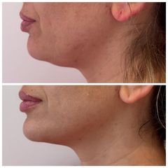 XV Clinic -  Radiofrecuencia Facial
