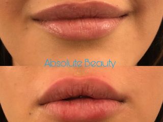 Antes y después Aumento de labios 