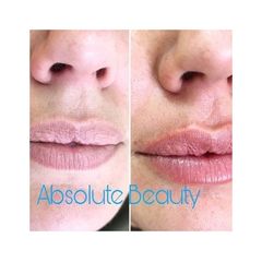 Antes y después Aumento de labios - Absolute Beauty