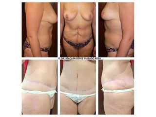 Antes y después Abdominoplastia
