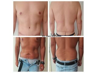Antes y después Abdominoplastia